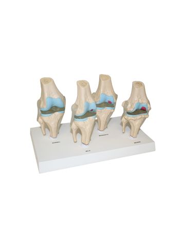 Knee Joint Diseases Model