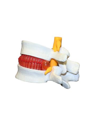 Prolapsed Invertebral Disc