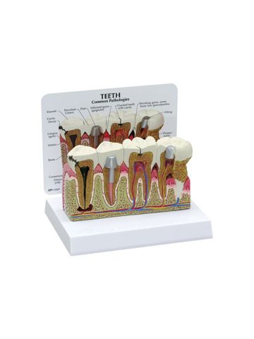  Teeth Model with Pathologies